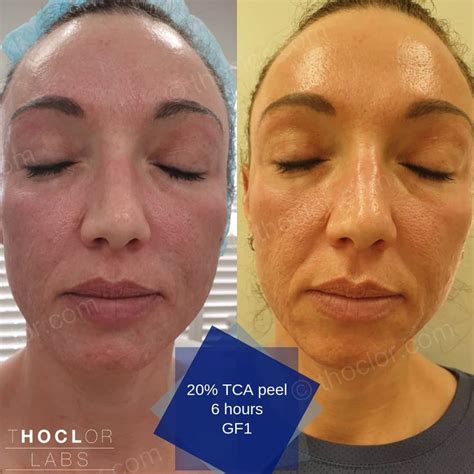 tca peel reviews|TCA Peel .